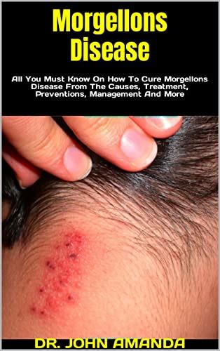 Morgellons Disease : All You Must Know On How To Cure Morgellons ...