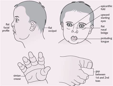 DOWN SYNDROME - Somali Kidshealth