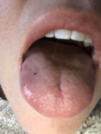 Any idea what this Black spot on my tongue is? | BabyCenter