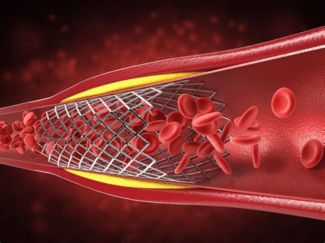 Balloon Angioplasty Procedure | Mijn Gezondheidsgids