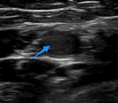 US4TW Case: 74F with Right Arm Tingling | Ultrasound for the Win series