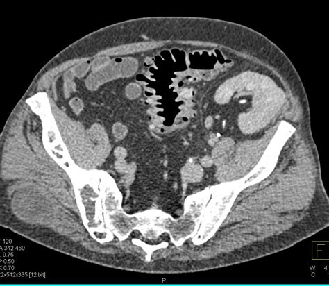 Rectal Cancer Home Remedies: Bowel Cancer Ct Scan