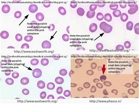 Haematology in a NutShell: Basophilic Stippling