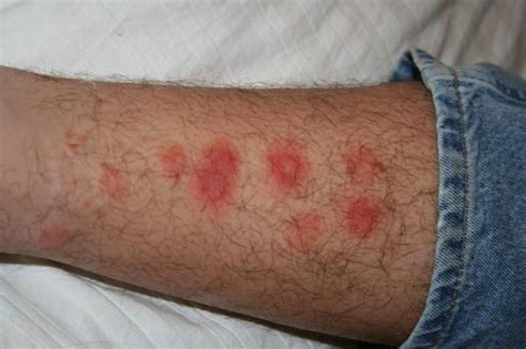 Help, I'm getting bit! A Guide to identifying bug bites. — Expert Pest Control