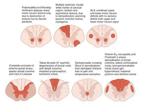 MBBS Medicine (Humanity First): Spinal Cord Lesions - USMLE high yield ...