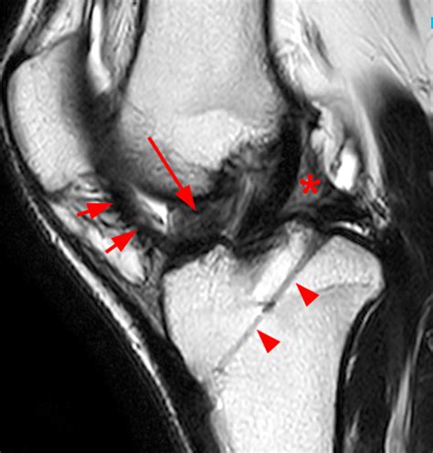 Arthrofibrosis of the Knee - Radsource