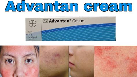 Advantan cream uses and benefits (methylprednisolone) side effects How ...