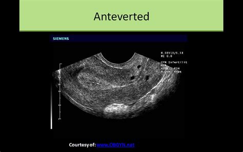 Anteverted Uterus on Ultrasound | Ultrasound technician, Ultrasound ...