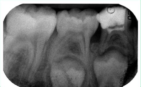 MTA placement after cameral pulpotomy. | Download Scientific Diagram