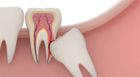 Wisdom-Tooth-Impaction - Pacific Oral Surgery