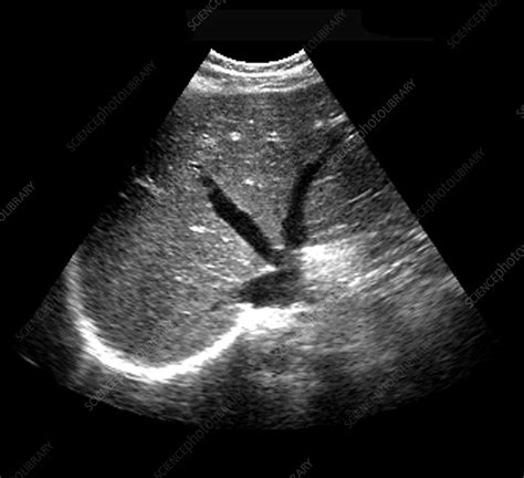 Liver & Hepatic Veins, Ultrasound - Stock Image - C003/4699 - Science Photo Library