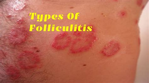 Folliculitis: What Is Folliculitis? Its Symptoms, Causes, And More