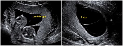 Ultrasound surveillance in twin pregnancy: An update for practitioners - R Townsend, A Khalil, 2018