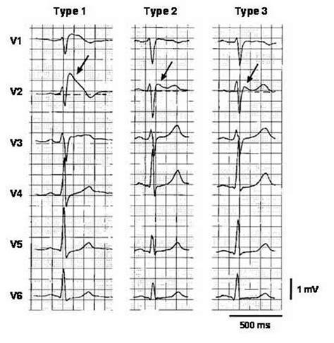 Brugada Syndrome - Causes, ECG, Symptoms, Treatment