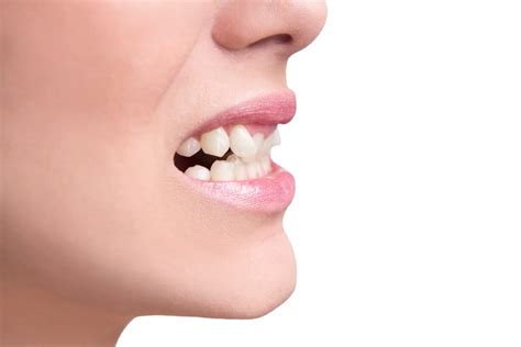 Veneers vs Braces: Which Is Right for Fixing Crooked Teeth? - University Dental San Diego CA