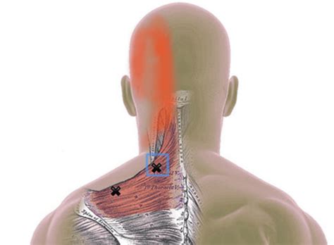 Trapezius Trigger Points