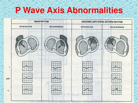 PPT - Pediatric EKG PowerPoint Presentation, free download - ID:6615863