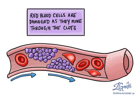 Trombotisk mikroangiopati (TMA) | MyPathologyReport.ca