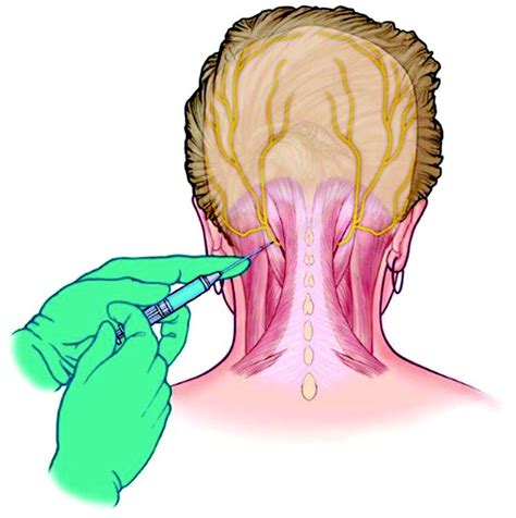 Para un día de viaje Destilar lento occipital neuralgia nerve block ...