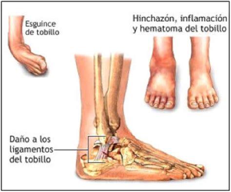 Prevención y Recuperación de Lesiones en el Deporte: ESGUINCE DE TOBILLO