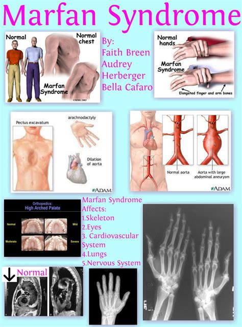 Marfan Syndrome | | Marfan syndrome, Cardiovascular system, Syndrome