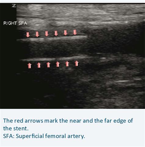 10. Stent in the right superficial femoral artery. | Download Scientific Diagram