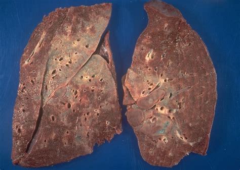 Sarcoidosis - Lung granulomas | Flickr - Photo Sharing!