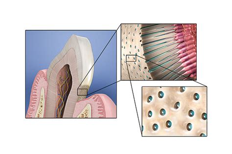 Dentin Hypersensitivity | Jan/Feb 2011 | Inside Dental Assisting