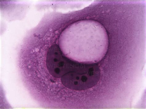 Koilocytes, squamous epithelial cells, altered by human papillomavirus stock photo