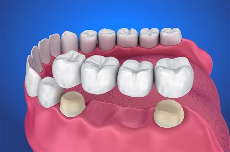 Dental Crowns & Dental Bridges in Coral Gables - South Gables Dental