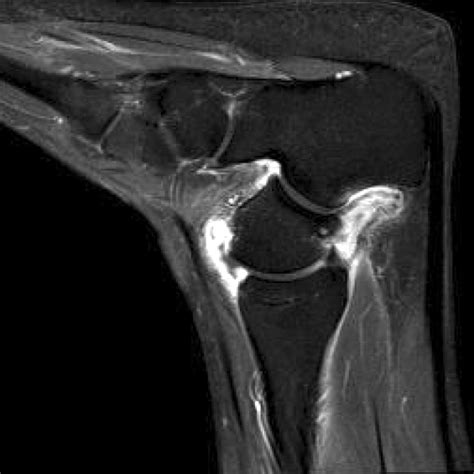 On axial (A) and sagittal (B) view of the magnetic resonance imaging,... | Download Scientific ...