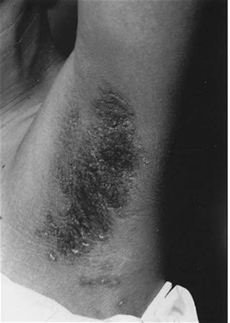 Doctors Gates: Acanthosis nigricans in diabetes mellitus