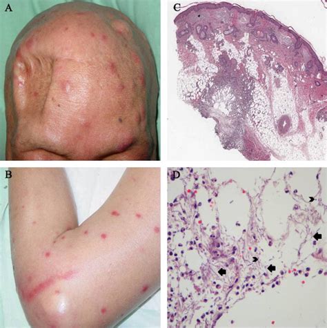 The importance of skin biopsy in the diverse clinical manifestations of ...