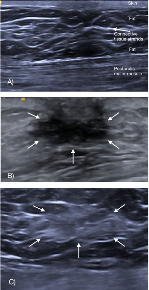 Male Gynecomastia Ultrasound