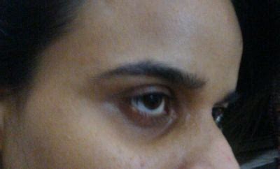 Hollow Eye at 25 Age , Because of Dehydration and Stress, Right Eye ...