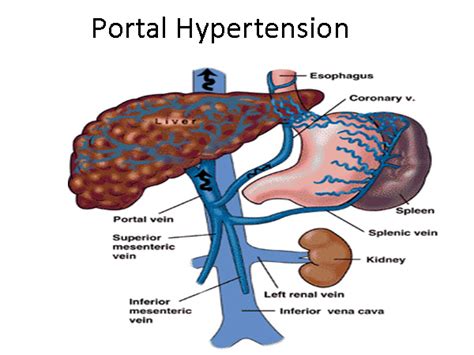 Portal Hypertension