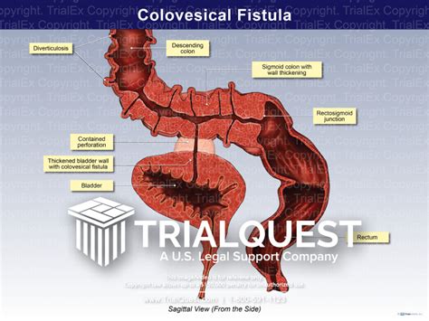 Colovesical Fistula - TrialExhibits Inc.