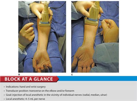 Untado gas Escuela de posgrado radial nerve block ultrasound fácilmente ...