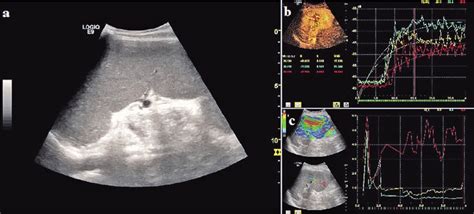 Splenomegaly. a) 2-D ultrasound – enlarged spleen; b) CEUS –... | Download Scientific Diagram