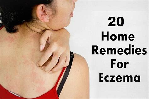 20 Best Natural Home Remedies for Eczema in Adults