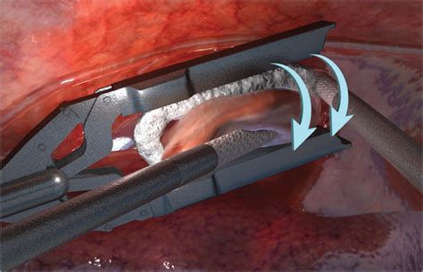 Subxiphoid Minimally Invasive Epicardial Ablation (Convergent Procedure) With Left Thoracoscopic ...