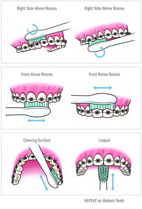 Brushing Technique for Patients with Braces – Uttam Dental Clinic