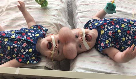 An Amazing Tale of Bravery: Conjoined Twins Reap Success With Successful Divorce Surgery – Fancy ...