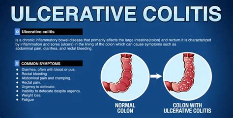 Peptic Ulcer Disease Explained Infographic Illustration Stock Vector by ...