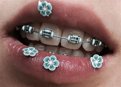 bracesaesthetic | Braces colors, Cute braces, Getting braces