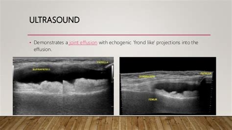 Lipoma Arborescens Ultrasound