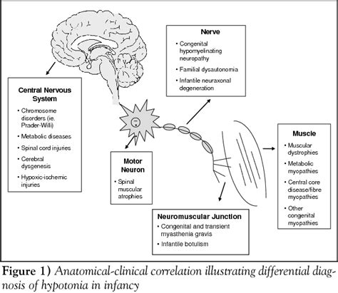 Figure 1 from A schematic approach to hypotonia in infancy. | Semantic Scholar