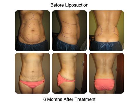 How Smart Liposuction Works | How Laser Liposuction Works