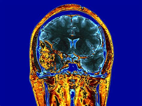 Gadolinium Contrast Agents and Brain Deposits: A Closer Look