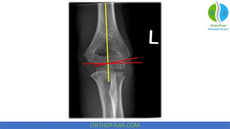 Baumann Angle For Elbow Joint Alignment | OrthoFixar 2024